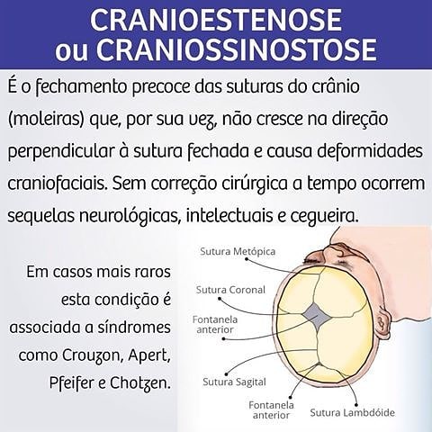 cranioestenose