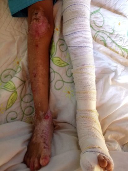 Rede de solidariedade: criança com doença rara precisa de material para curativos em Guarapari 2 rara