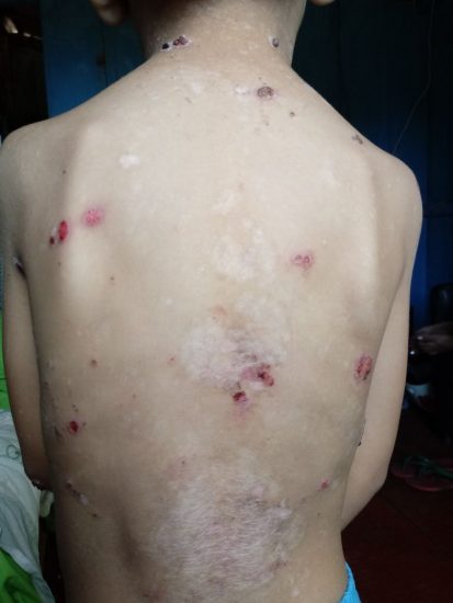 Rede de solidariedade: criança com doença rara precisa de material para curativos em Guarapari 1 rara2