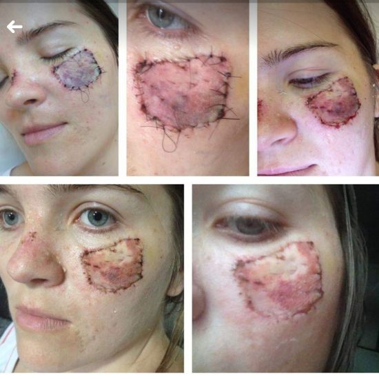 IMG 20181203 WA0026 - Moradora de Guarapari relata a luta contra o câncer de pele