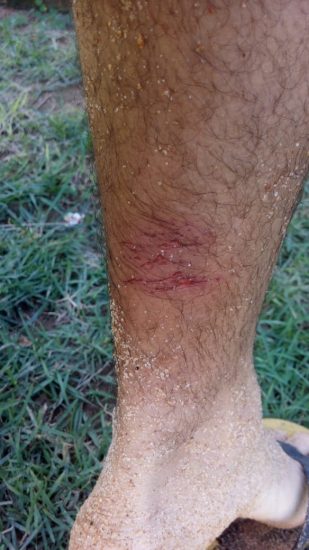 WhatsApp Image 2019 05 13 at 14.39.08 - Surfista ferido por linha questiona pesca em Setibão; Iema esclarece demarcação em Guarapari