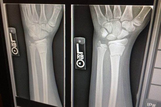 Após alegar diagnóstico médico errado, moradora de Guarapari recorre a justiça, mas tem pedido de indenização negado 1 fratura