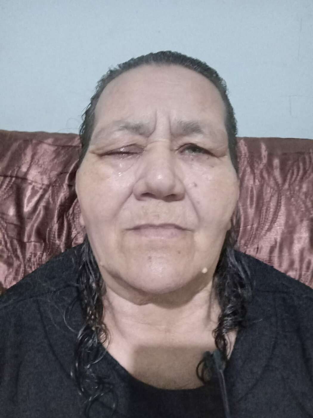 Sem especialista no ES, idosa de Guarapari pede ajuda para tratar tumor na órbita ocular em SP