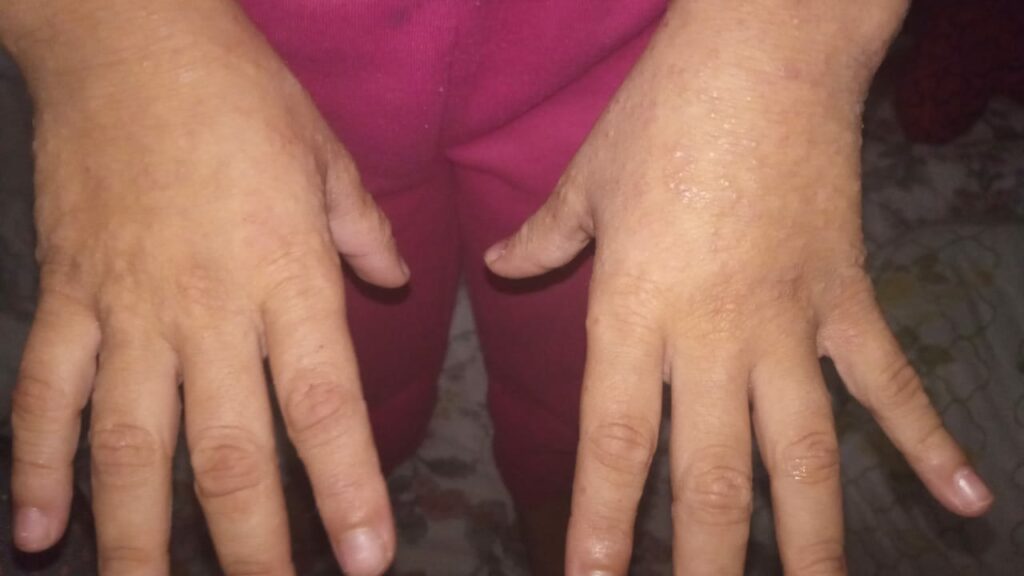 Vaquinha arrecada valores para criança com dermatite atópica em Guarapari