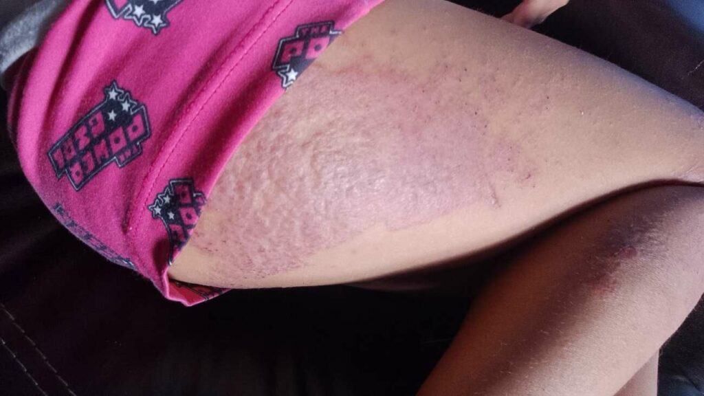 Vaquinha arrecada valores para criança com dermatite atópica em Guarapari