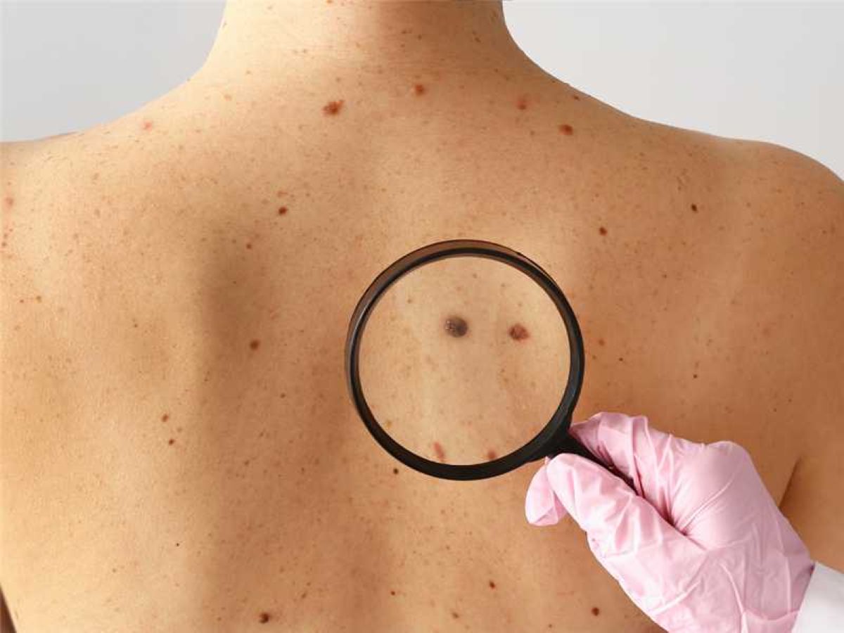 Mutirão contra o câncer de pele em Alfredo Chaves terá cirurgias; agendamento está aberto 1 cancer de pele