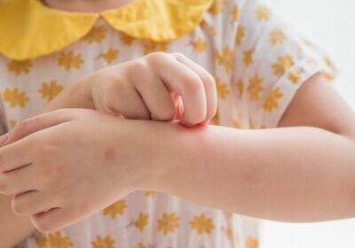 little-girl-has-skin-rash-allergy-itching-scratching-her-arm