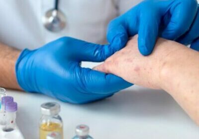 teste variola