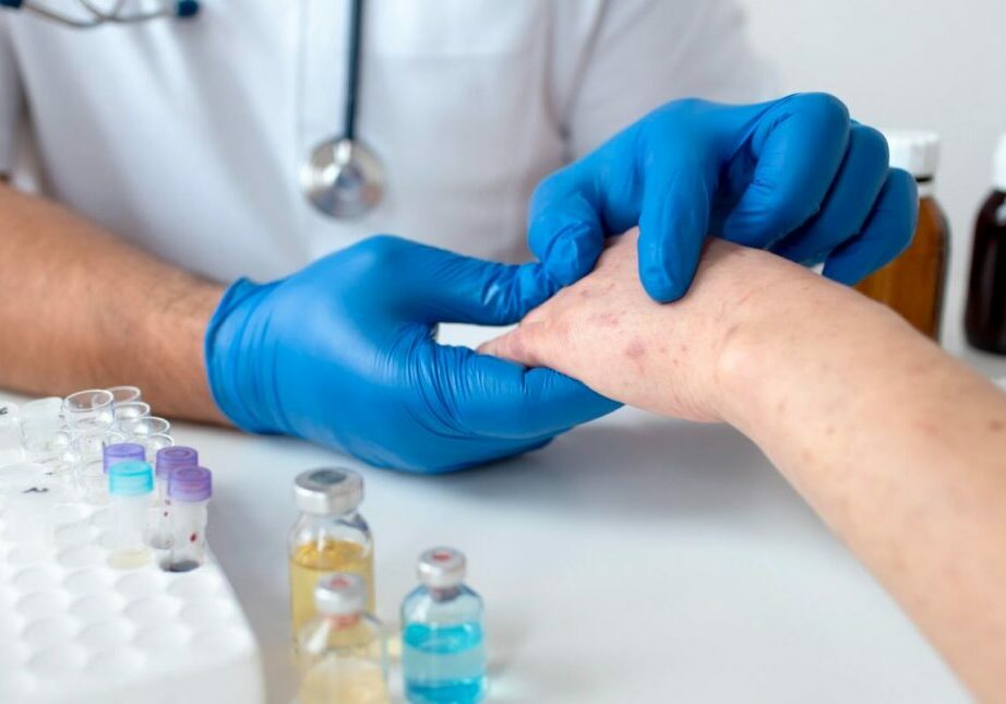 teste variola